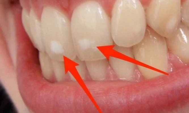 Πού οφείλονται αυτά τα λευκά σημάδια στα δόντια – Τι πρέπει να κάνετε